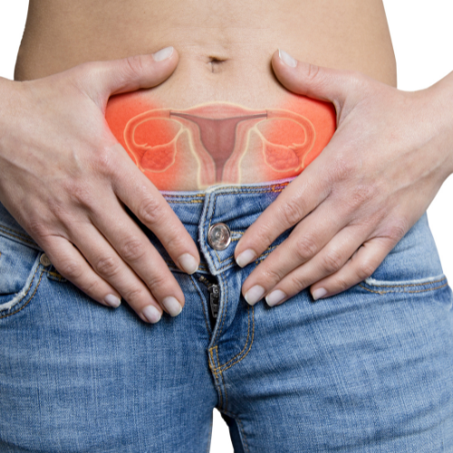 Az endometriózis és a petefészekrák tünetei hasonlóak lehetnek. 