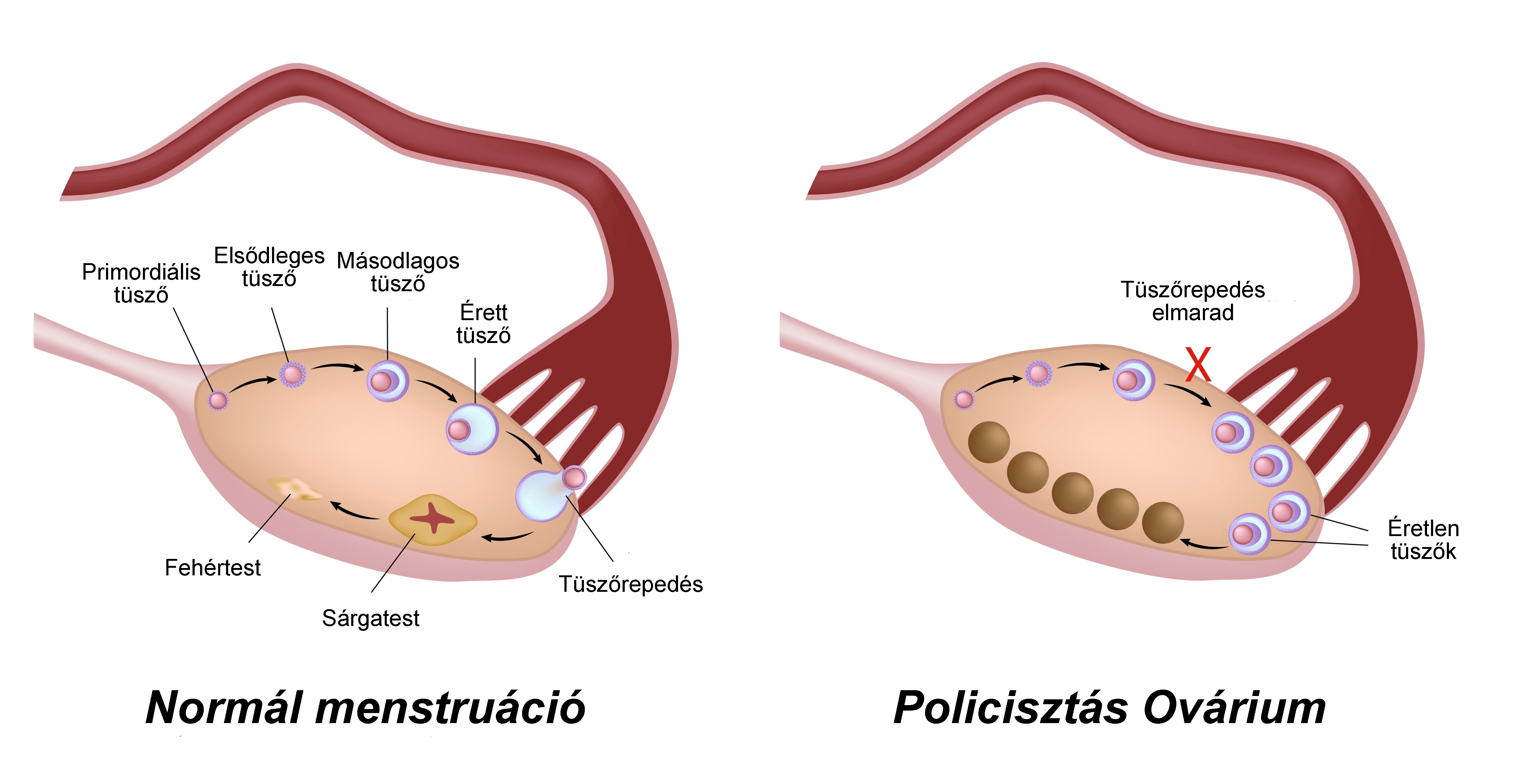 fogyás a pcos kezelésére