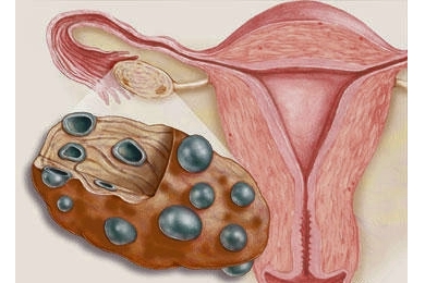 PCOS kivizsgálása és kezelése